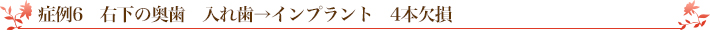 症例6　右下の奥歯　入れ歯→インプラント　4本欠損