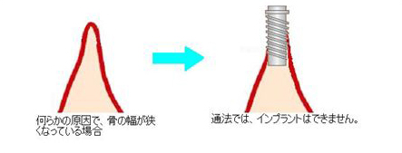 何らかの原因で、骨の幅が狭くなっている場合　通法では、インプラントはできません。