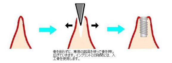 骨を削らずに、専用の器具を使って骨を押し広げていきます。インプラントとの隙間には、人口骨を使用します。