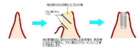 他の影響のない部分から採取した自家骨を、既存骨に合わせて整形し、チタン製のスクリューピンと人工骨にて固定します。